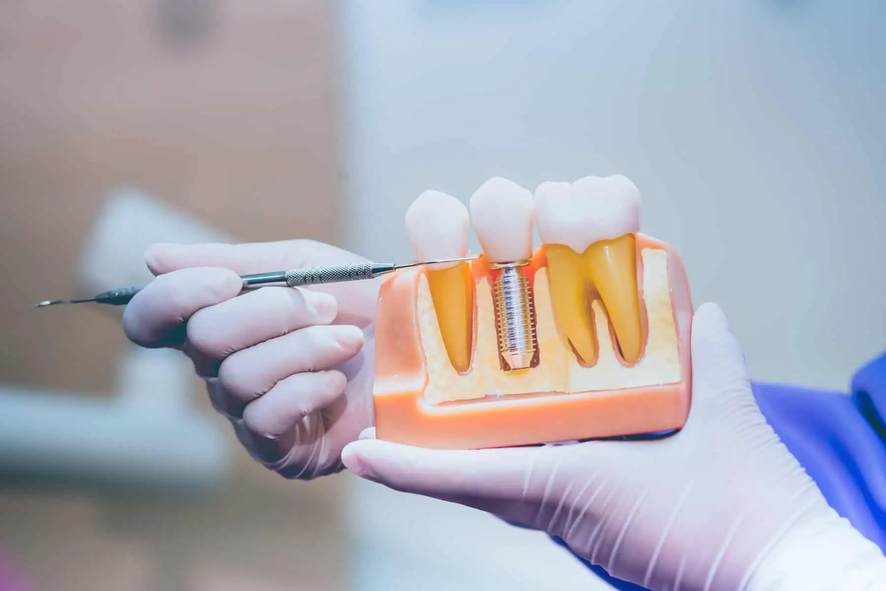 Dental Implants Colorado