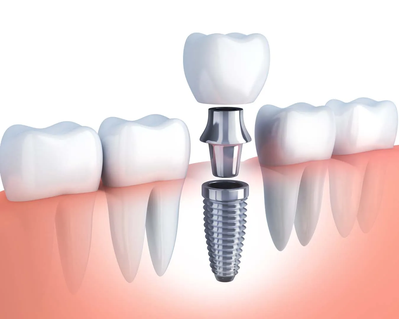 Dental implant diagram showing the titanium post, abutment, and crown — implant dentistry in Golden, CO