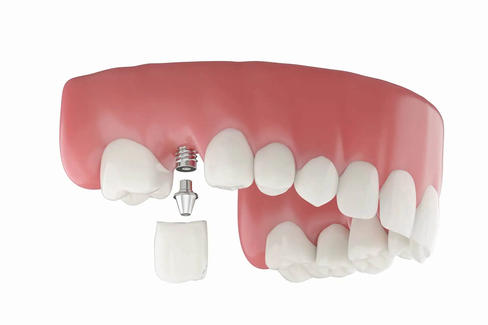 Dental implants in Golden, CO