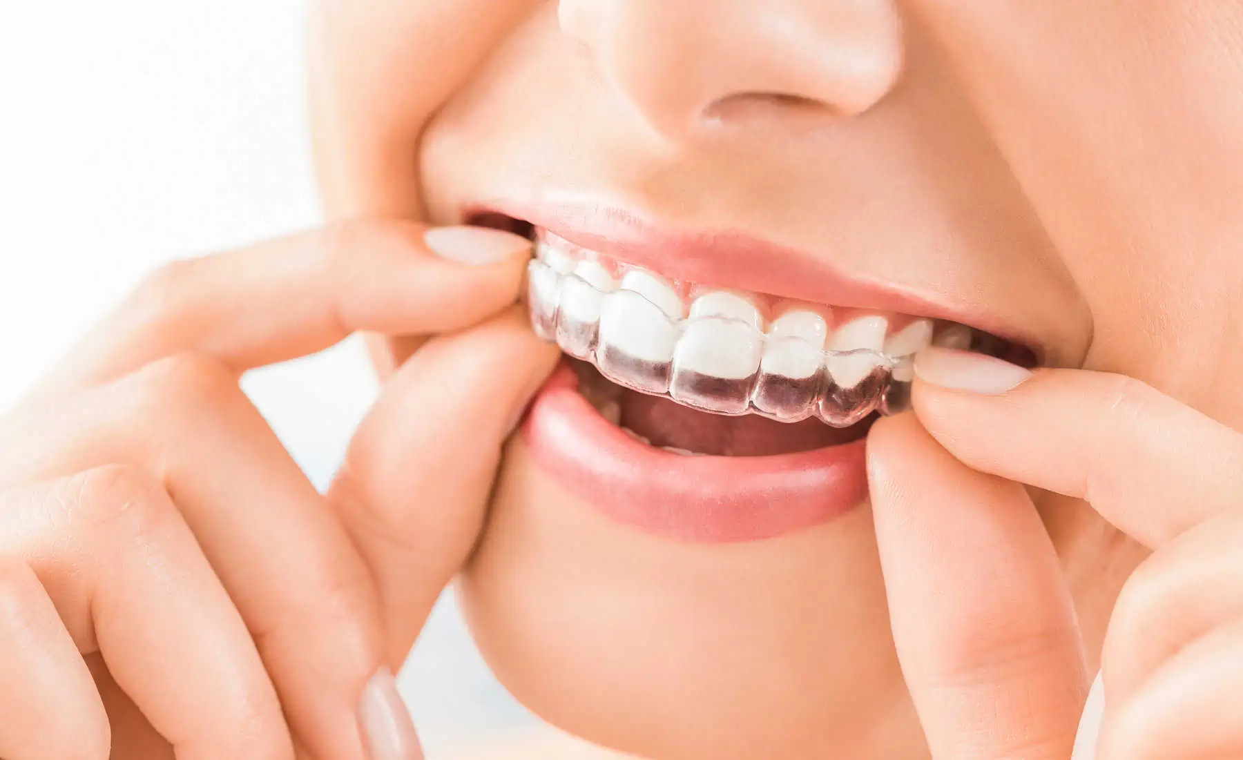 Invisalign clear aligners in Golden, CO