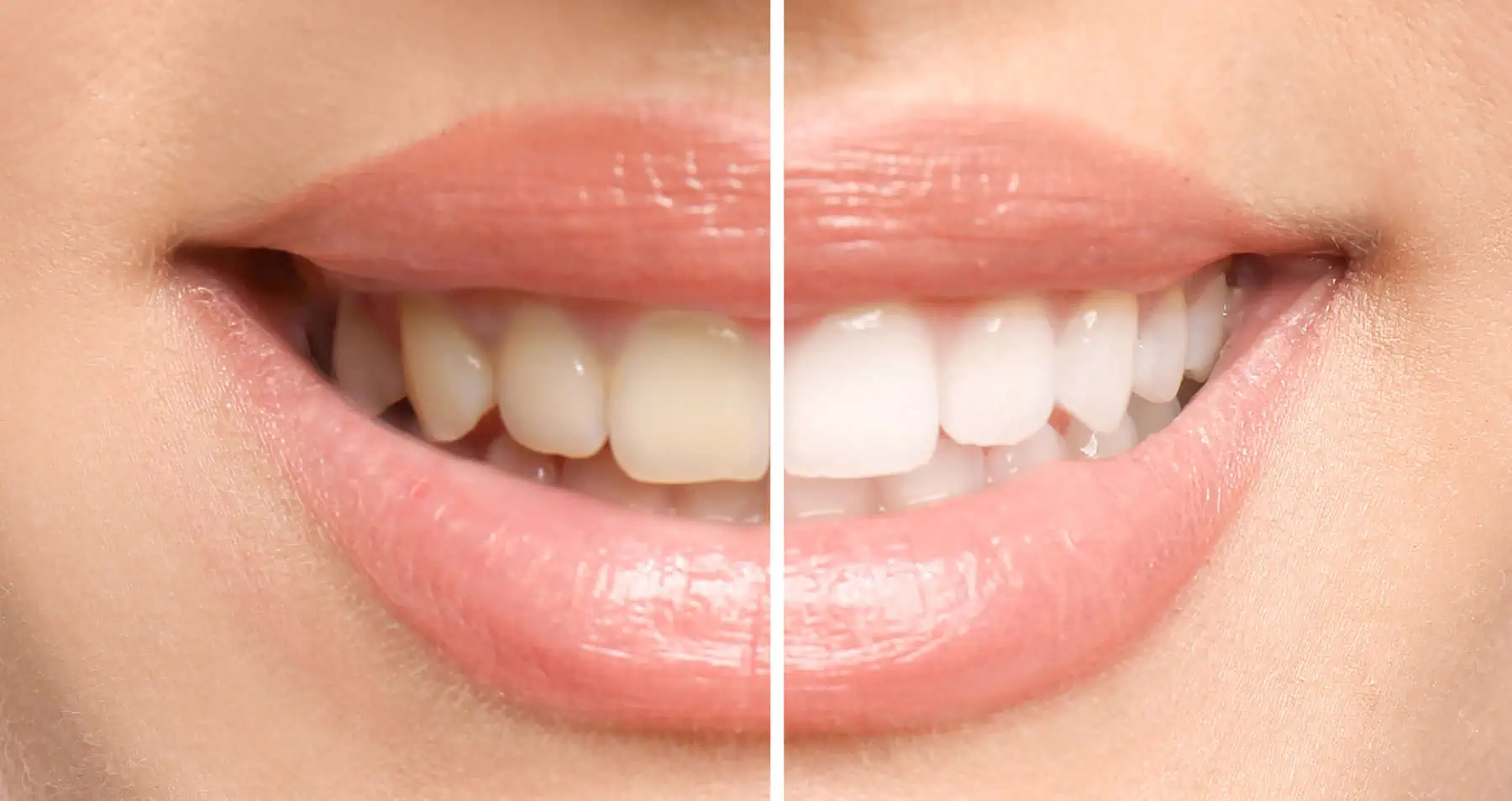 Teeth whitening in Golden, CO